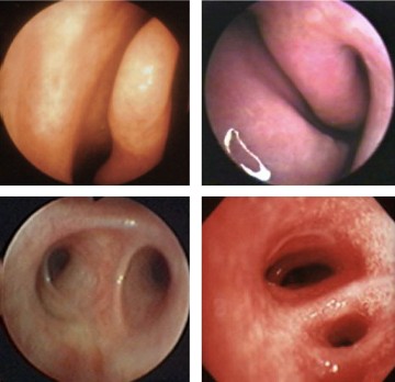 Allergische rinoconjunctivitis 