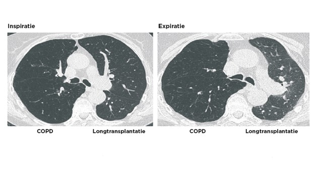 Bronchoscopische longvolumereductie voor patiënten met ernstig COPD