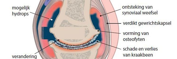 De KNGF-richtlijn Artrose heup-knie 2018
