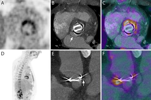 Beeldvorming van kunstklependocarditis