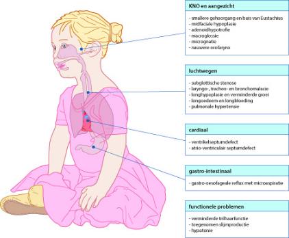 Verhoogd infectierisico bij kinderen met het downsyndroom 