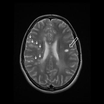 Multiple sclerose deel 1: pathofysiologie en behandeling (BD)