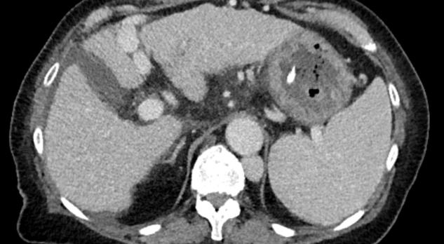 Screening van orgaandonoren met behulp van CT van thorax en abdomen
