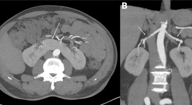 Fibromusculaire dysplasie bij hoefijzernier: toeval of oorzakelijk verband?