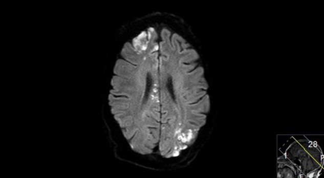 Primaire vasculitis van het centrale zenuwstelsel: diagnostiek en therapie