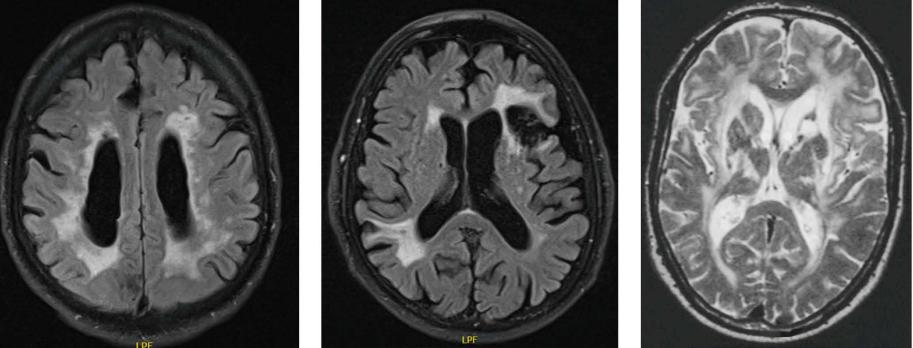 Vasculaire cognitieve beperking en vasculaire dementie 