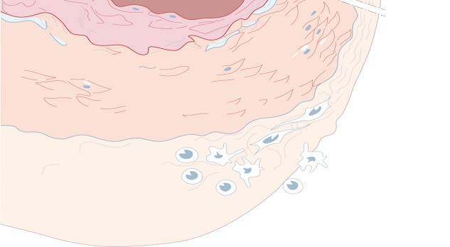 Classificatie van pulmonale hypertensie