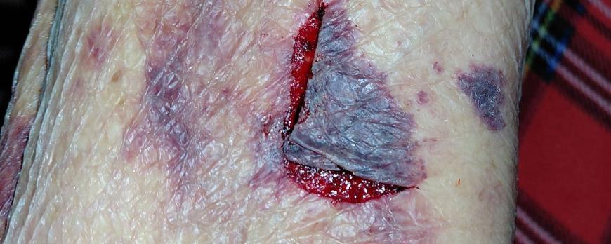 Skin tears