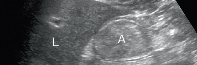 Echografische bepaling van maaginhoud en volume