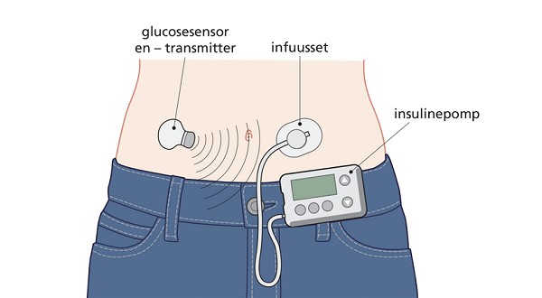 Insulinepompen en glucosesensoren op de OK