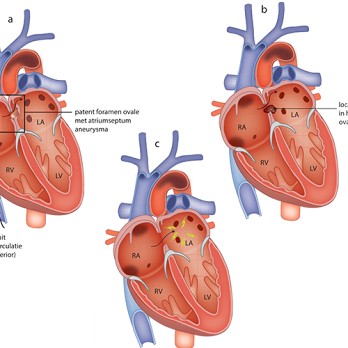 Patent foramen ovale als oorzaak van herseninfarct op jonge leeftijd 