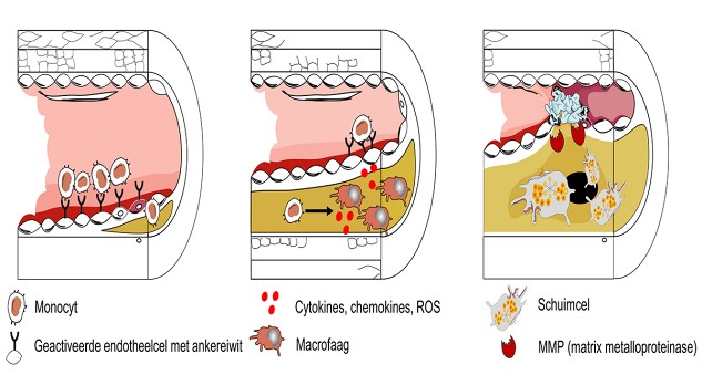 Lipoproteïne-gedreven inflammatie in atherosclerose