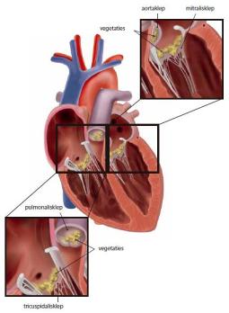 Endocarditis: een levensgevaarlijke aandoening