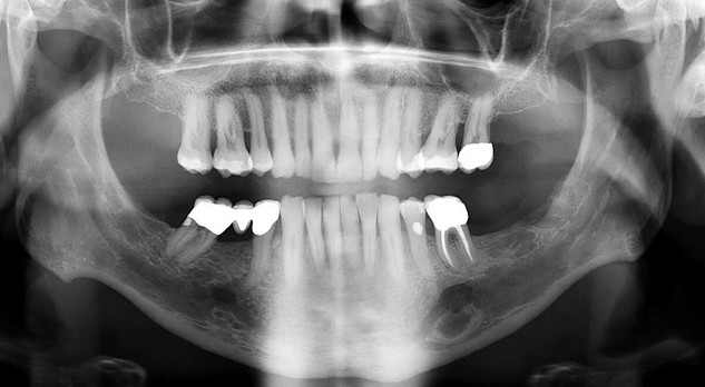 Bottumoren van het maxillofaciale skeletale complex 