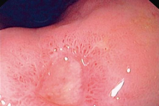 Naar gerichte diagnostiek van Helicobacter pylori-infecties