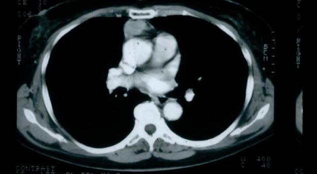 Neuromusculaire overgangsstoornissen