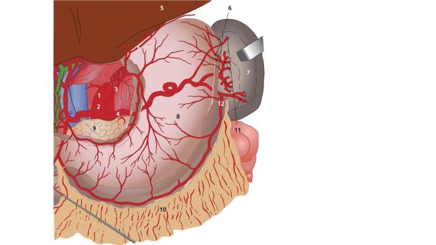 Embolie uit arteria lienalis-aneurysma als oorzaak van een miltinfarct