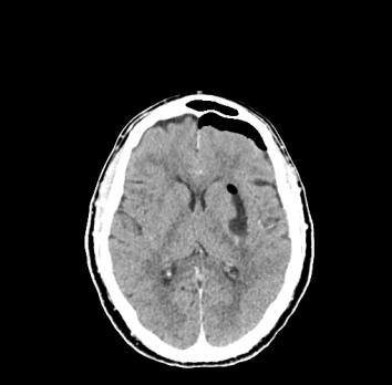 Accidentele ingestie van een etsend middel op de kinderleeftijd: is endoscopie altijd nodig?