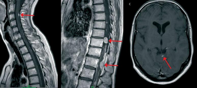 Multidisciplinaire zorg in de neuro-oncologie