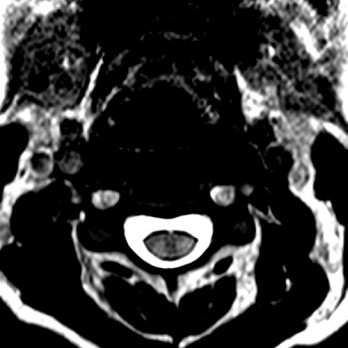 Beeldvorming van myelumlaesies 