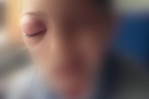 Plaatjespuzzel: een jongen met een dik rood oog