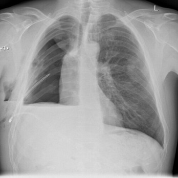 Postpneumonectomie bronchopleurale fistel