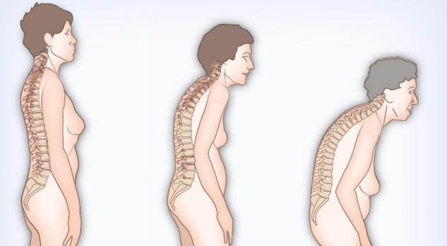 Osteoporose in beweging (VI)