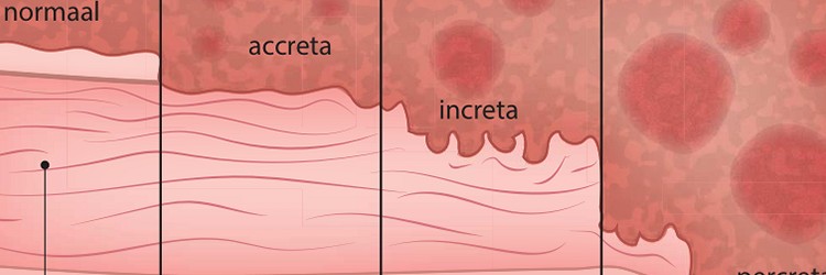 Haemorrhagia post partum 