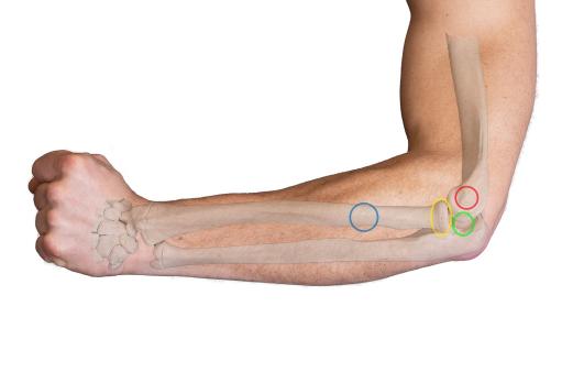 Diagnostiek en behandeling van laterale elleboogtendinopathie (AF, BD)
