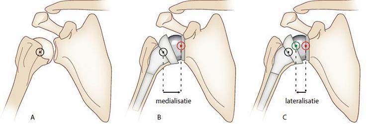 Fysiotherapeutische revalidatie bij de schouderprothese