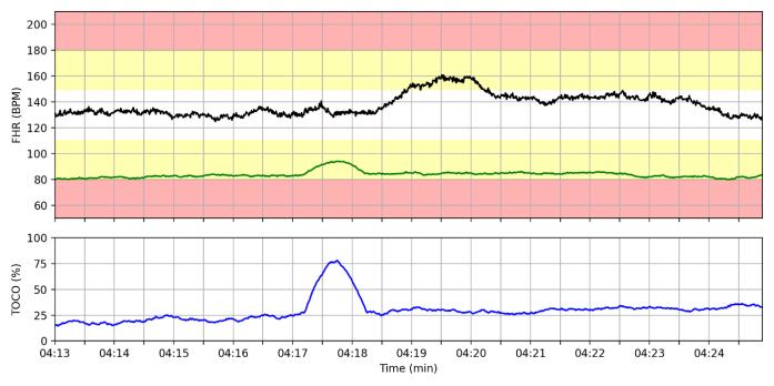 Foetaal monitoren tijdens de zwangerschap en bevalling