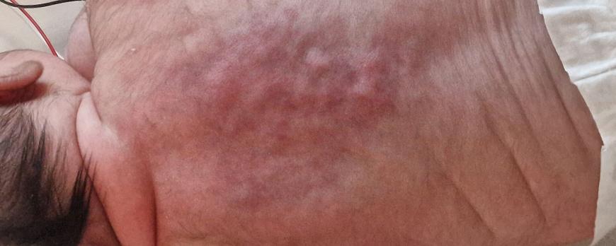 Plaatjespuzzel: een blauwpaarse, hobbelige neonaat met pijn