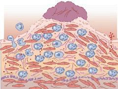 Slagaderverkalking, ontstaan en behandeling