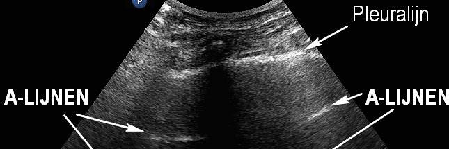 Echografie van de pleura en longen