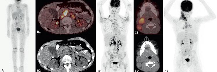 Beeldvormend onderzoek met PET-CT bij kinderen