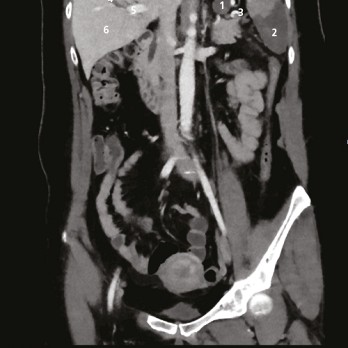 Embolie uit arteria lienalis-aneurysma als oorzaak van miltinfarct