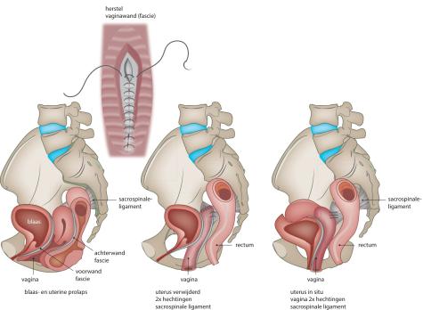 Sedatie bij gynaecologische ingrepen