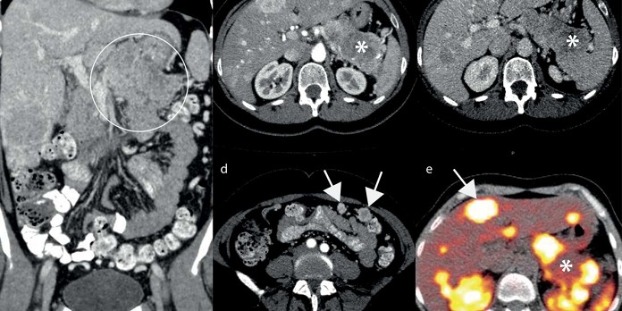 Beeldvorming van gastro-enteropancreatische neuro-endocriene tumoren