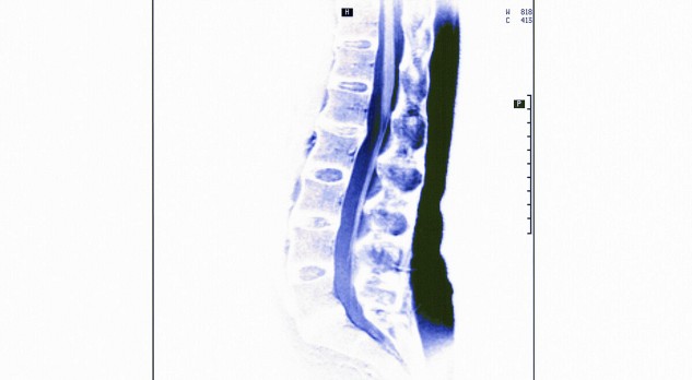 Spina bifida