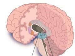 Een patiënt met de ziekte van Parkinson