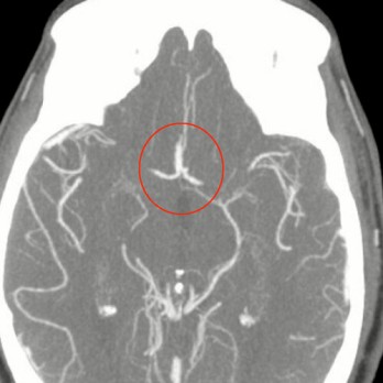 Herseninfarcten door occlusie van de arteria cerebri anterior