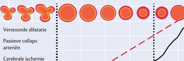 Bloeddrukregulatie bij acute neurologische aandoeningen 