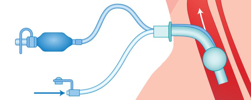 Het plaatsen van een tracheacanule op de Intensive Care