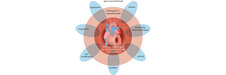 Perioperatieve myocardschade bij niet-cardiale chirurgie 