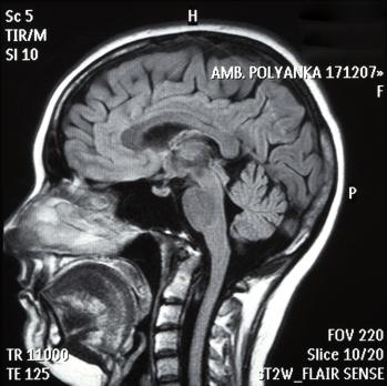 Screening van hormonale uitval na traumatisch hersenletsel