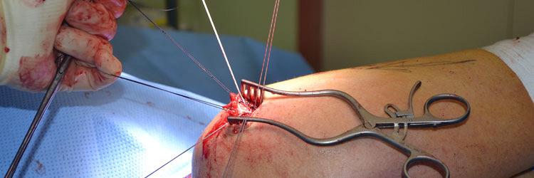 Latissimus dorsitranspositie bij massieve posterosuperieure rotator cuffrupturen