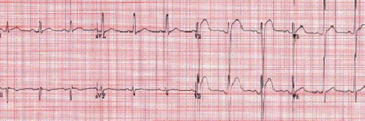 Ernstige hypercalciëmie op de Intensive Care 