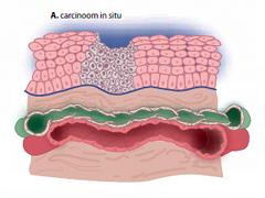 Begeleiden van patiënten met botmetastasen