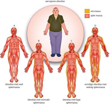 Fysiotherapie bij artrose: (h)erken de patiënt met sarcopene obesitas (VI)