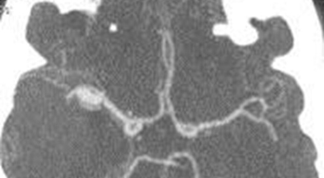 Intracerebrale bloeding